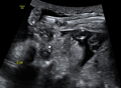 胎兒的健康檢查 新竹馬偕高層次超音波2016 雪花台湾