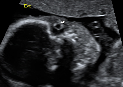 胎兒的健康檢查 新竹馬偕高層次超音波2016 凱薩琳一家四口 痞客邦