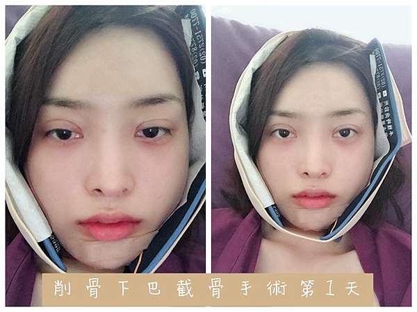 05削骨下巴截骨 手術到術後三天煎熬必讀篇 內有骨頭照 Lynn的不寂寞星球 痞客邦