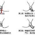 痔瘡四級.jpg