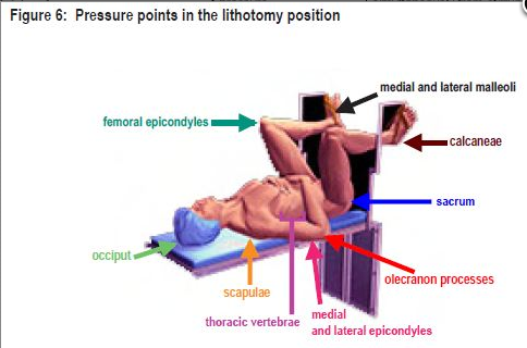 Lithotomy Position