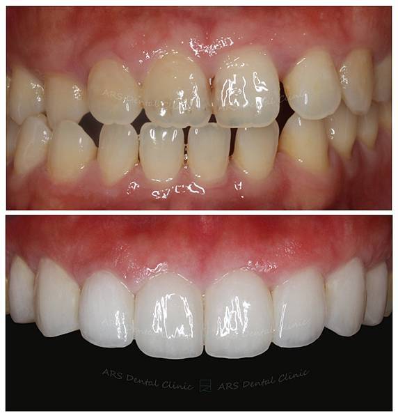 Q-Veneer+全瓷冠#14-#24 (13088) G