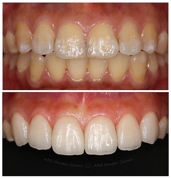 Z-Veneer#13-#23 (5468) G