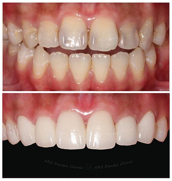 Q-全瓷冠#13-#23 (2770) G