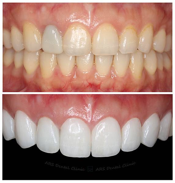 Q-全瓷冠#14-#24 (11094) G