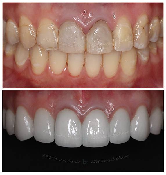 Z-C.L.S#14-#24&全瓷冠#14-#24 (6877) G