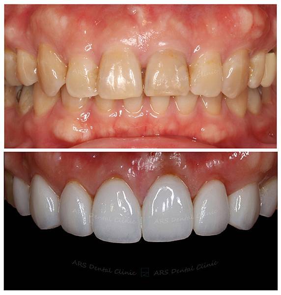 Z-CLS+Veneer+全瓷冠#14-#24 (12075) G