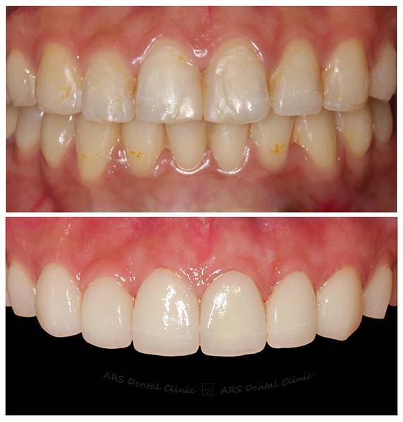 Q-Veneer#13-#23 (3317) G