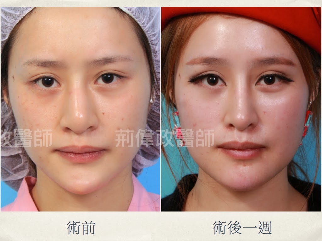 注射隆鼻風險高 手術隆鼻該注意的5件事 璞美整形美學新演繹 璞美學顏面整形新演繹 割雙眼皮 縫雙眼皮 雙眼皮重修 結構式隆鼻 隆鼻重修 提眼肌 前額拉提 提眉 內視鏡隆乳 私密美形