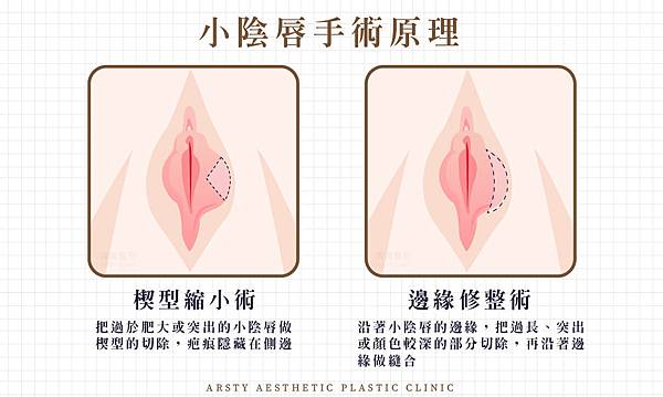 邊緣修整、楔型縮小-手術.jpg