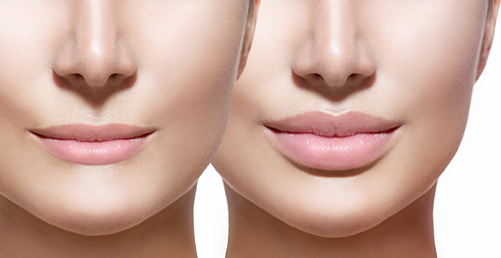 lip-augmentation.jpg lip-augmentation.jpg
