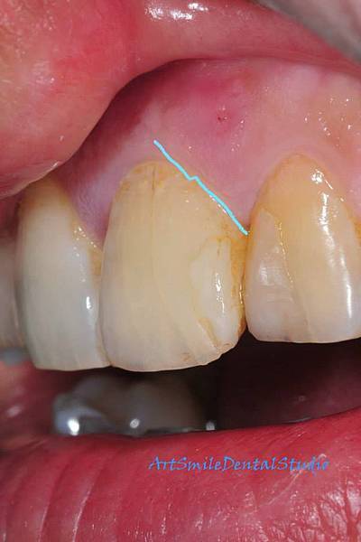 從側面觀，斷裂面如藍線，唇側面在牙齦下，所以看不出來