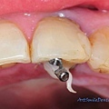 在牙齒中央打洞，復位後打入黏劑用金屬柱連結支撐