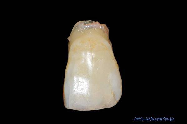 病人在手術前需要一顆臨時牙，斷裂的牙齒完整，是用來做臨時牙的最好材料