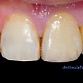 病人覺得前面左邊(病人為主)牙齒(牙位21)搖晃且有些許疼痛