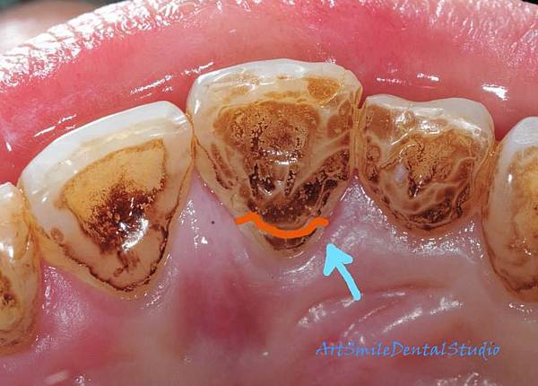 箭頭所指的橘線就是裂縫，証明牙齒完全斷裂