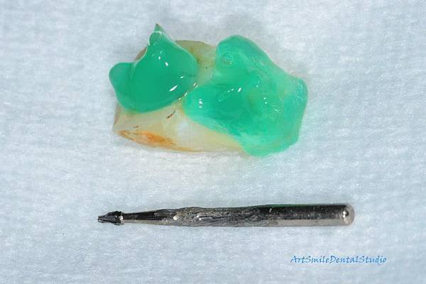 牙齒酸蝕處理以利黏結，利用一金屬柱當臨時釘