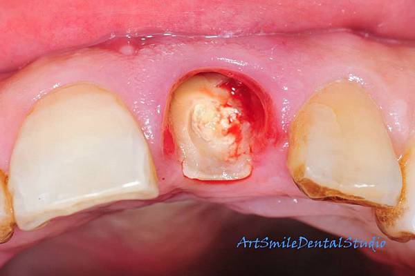斷裂的牙齒取下後