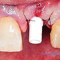 馬上拔牙馬上植牙，植牙後接出臨時支架