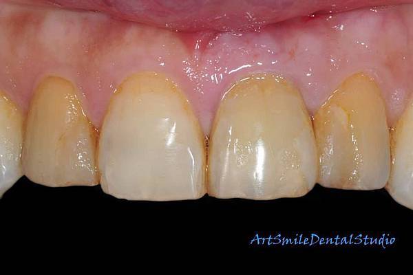 斷裂牙黏回(病人左側，我們現在看的右側，牙位21)，復原良好，準備植牙