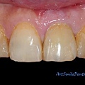 斷裂牙黏回(病人左側，我們現在看的右側，牙位21)，復原良好，準備植牙