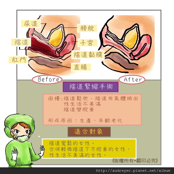 陰道緊縮手術 Dr 李偉浩婦產小天地 痞客邦