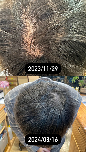 沐塔洗髮精實際使用情況,禿頭狀況明顯改善,內有前後對比圖! 沐塔洗髮精實際使用情況,禿頭狀況明顯改善,內有前後對比圖!