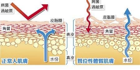 異位性皮膚炎