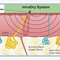 miraDry_04