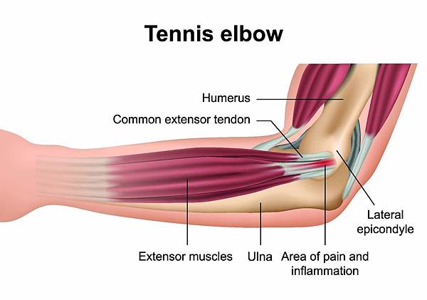 tennis-elbow.jpg