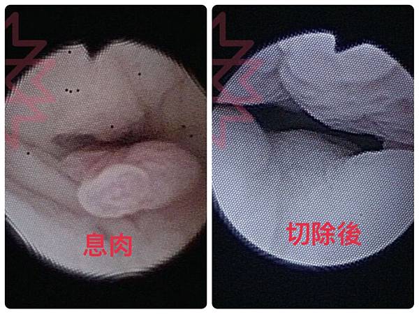 [心得] 禾馨韓健明冷刀息肉手術經驗分享