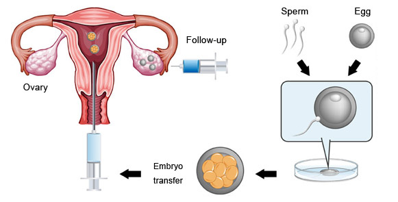 ivf試管嬰兒流程
