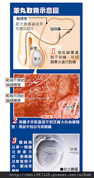 副睪取精