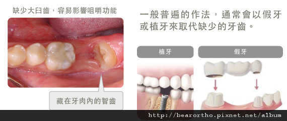 倒下的智齒02.jpg