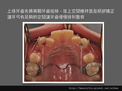 虎牙 凌亂 不整齊 malalignment, crowded.006