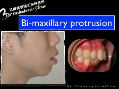 暴牙不整齊 bi-maxilary protrusion, crowded.001