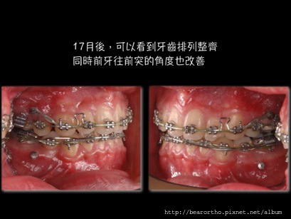 暴牙不整齊 bi-maxilary protrusion, crowded.010