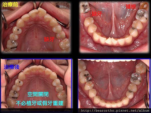利用矯正將缺牙的空間與爛牙根(殘根)的空間關閉