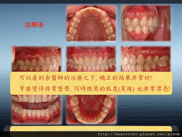 暴牙牙縫大不拔牙矯正.005.jpg