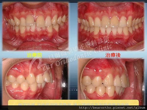 暴牙牙縫大不拔牙矯正.008.jpg