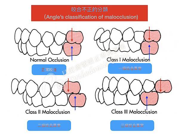 咬合不正分類.002.jpeg