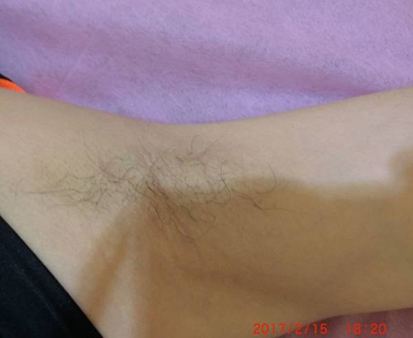 雷射除毛 雷射除毛