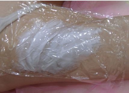 雷射除毛 雷射除毛