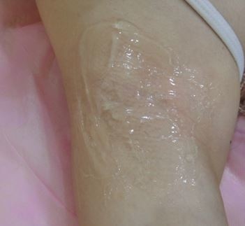 雷射除毛 雷射除毛