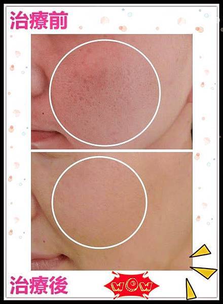 飛梭雷射 飛梭雷射