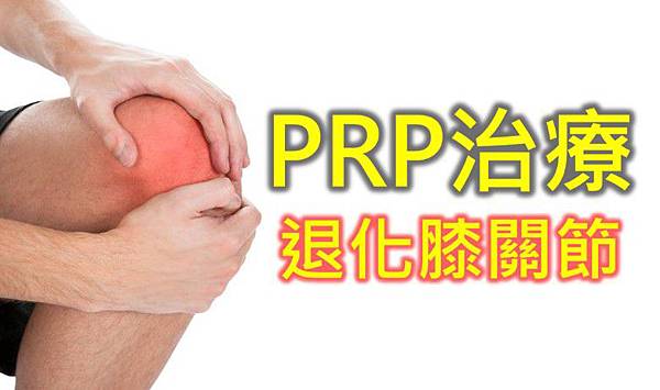 「關節炎 PRP注射」的圖片搜尋結果