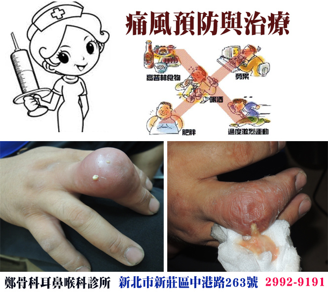 治療 痛風