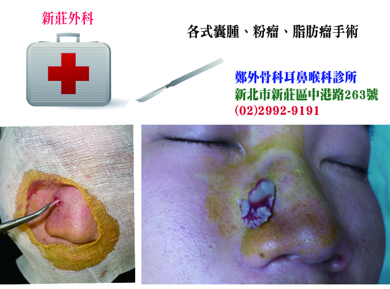 新莊外科 青春痘還是粉瘤 麗姿添身 新莊醫美 痞客邦