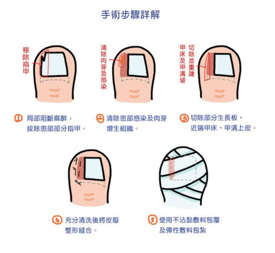 拔指甲手術