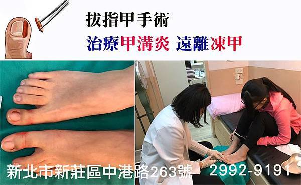 新莊拔指甲手術，凍甲、甲溝炎治療